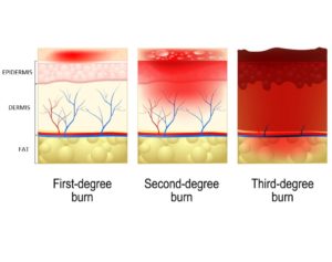 second degree burn scar