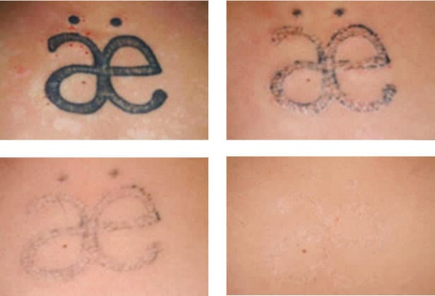 Laser tattoo removal less pain no redness tattoo will fade Without  scarring